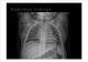 acute bronchiolitis   (12 )